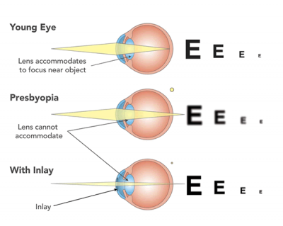 Corneal Inlay & Kamra