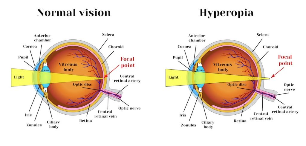 Causes of farsightedness