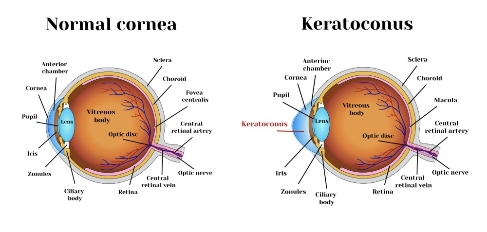 Causes of keratoconus