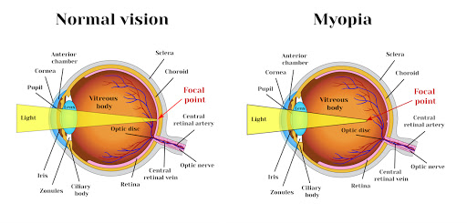  Causes of nearsightedness
