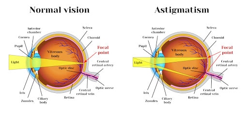Causes of astigmatism