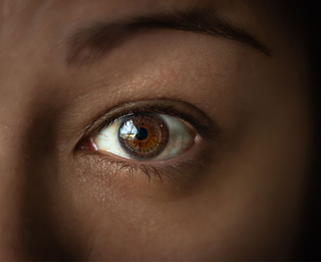 Keratoconus